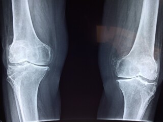 x-ray of the knee joints