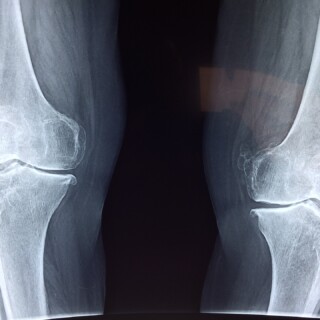 x-ray of the knee joints